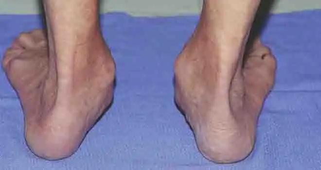 Flat Foot Reconstruction